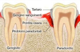 Tartaro e problemi parodontali